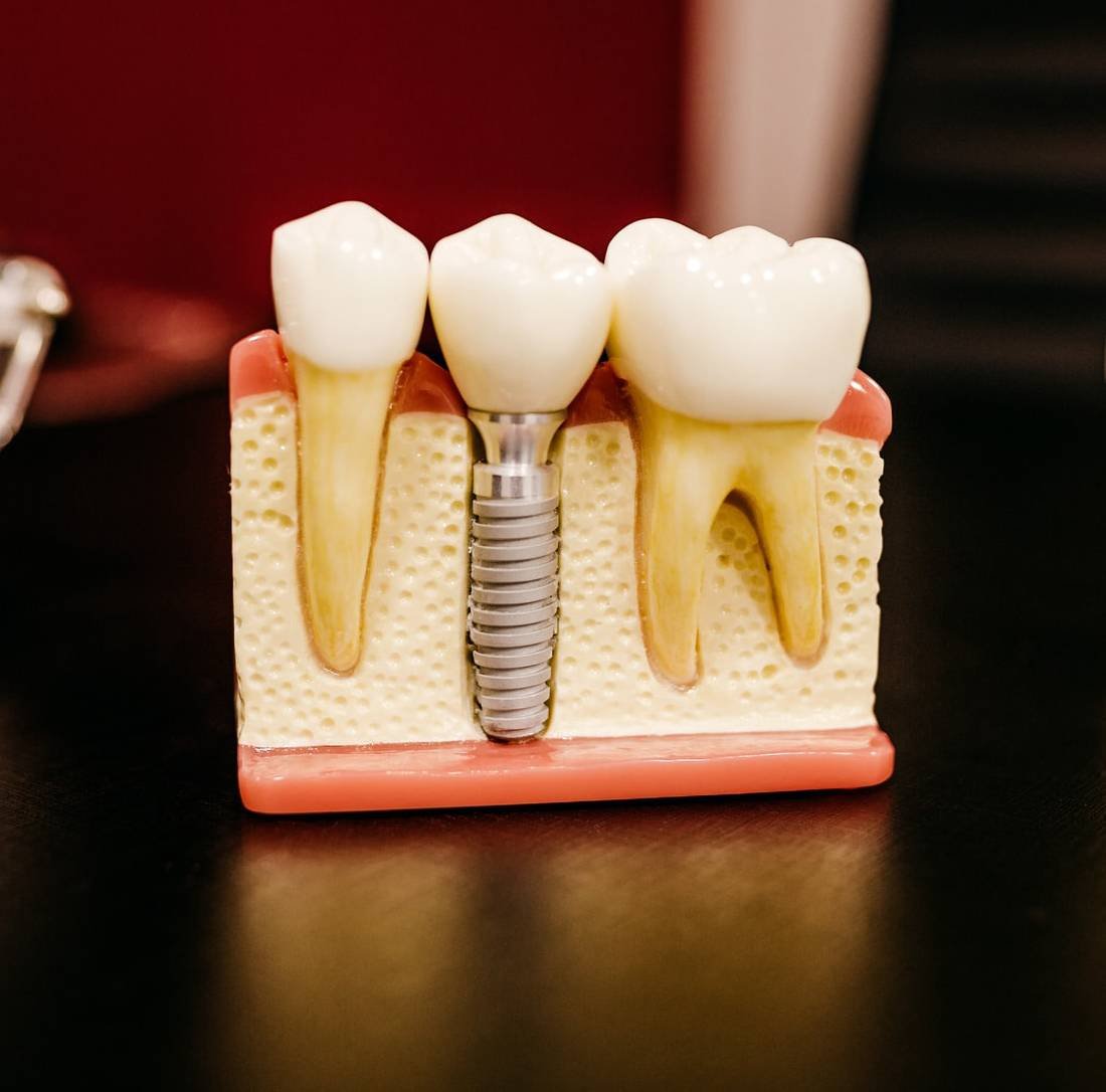 implanturi-dentare-moldova
